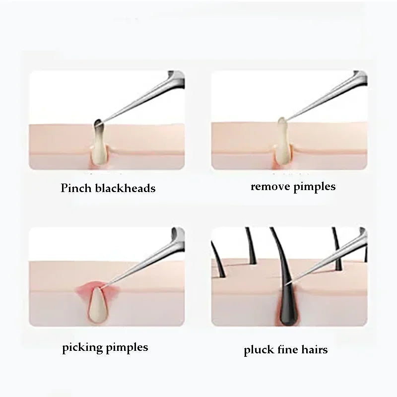4–11PCS Blackhead Removal Tool Kit – Tweezers & Acne Needle Set